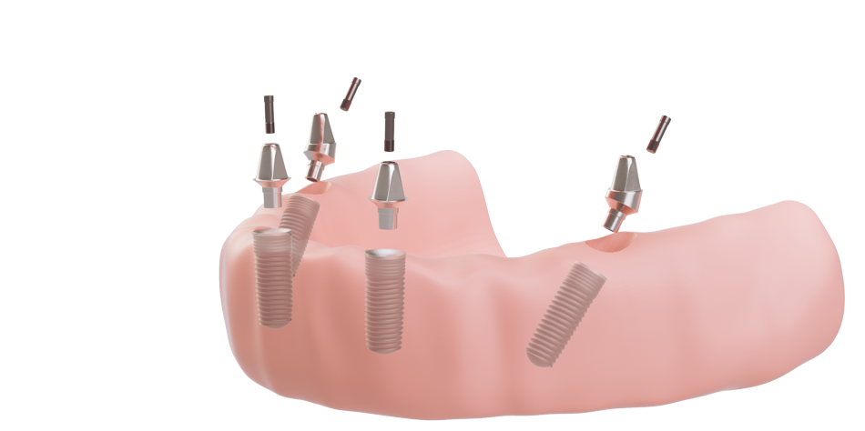 Darstellung der Aufbauten, die auf den eingesetzten All-on-4-Implantaten befestigt werden.