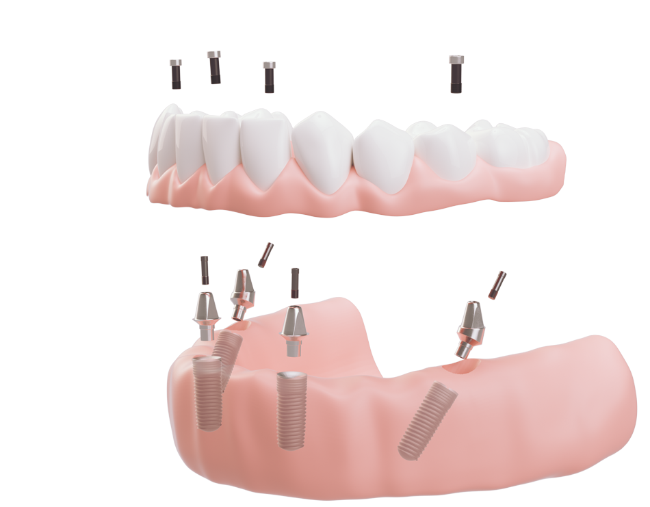 Darstellung des Zahnersatz-Provisoriums, das auf den Aufbauten der All-on-4-Implantate befestigt wird.