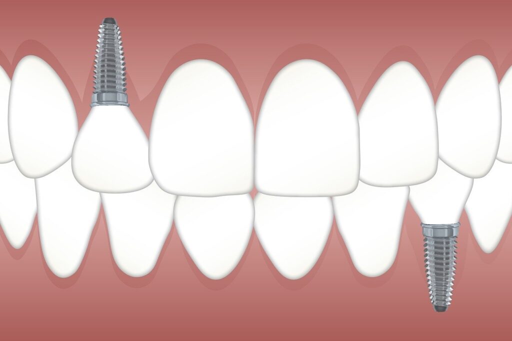 Illustration eines Gebisses mit einem Implantat im Unterkiefer und einem Implantat im Oberkiefer.