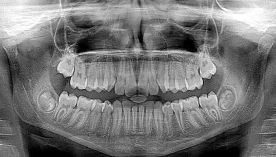 Röntgenaufnahme vom Kiefer